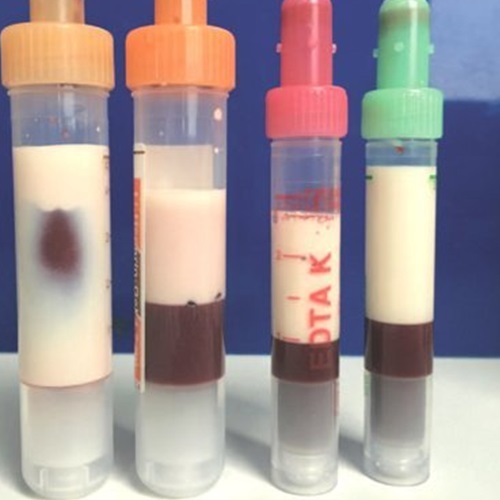 sangue Entenda porque um homem na Alemanha tinha o sangue branco sangue
